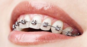 What do we all know about braces ?